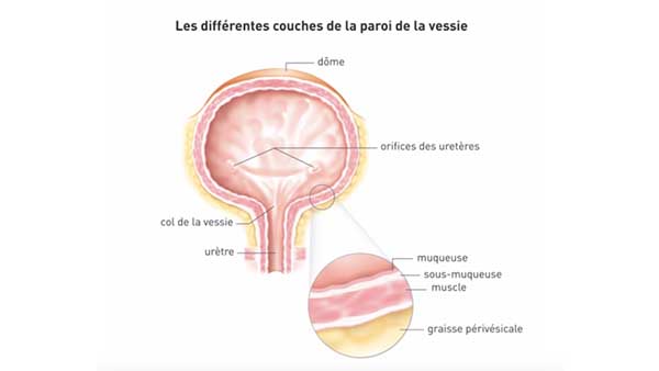 Cancer de vessie - Centre Urologie Sud Parisien Cancérologie